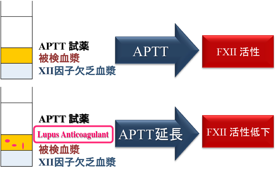 凝固第XII因子活性測定法とループスアンチコアグラントの影響