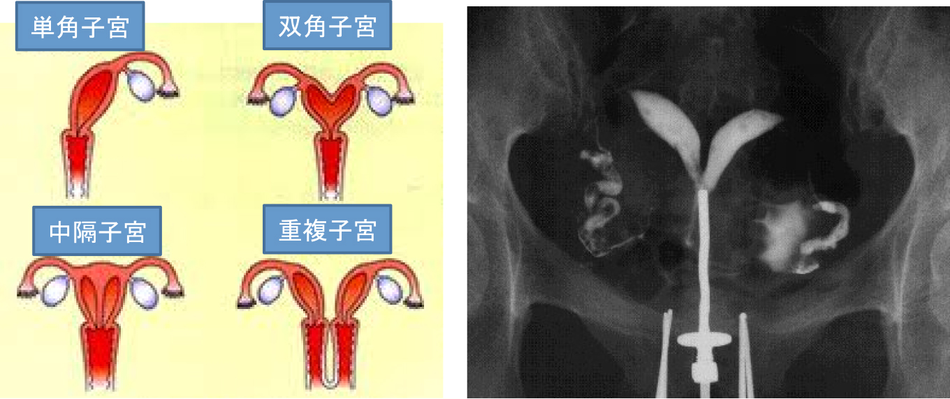 子宮奇形の分類