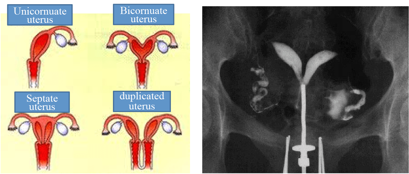 Congenital uterine anomalies